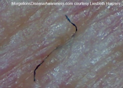 Morgellons_fiber.305101430_std